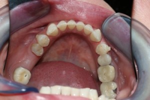 Missing tooth, dental implants