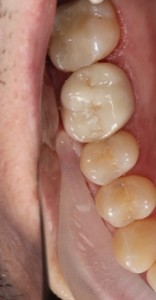 All ceramic crown, tooth crown, cosmetic crown