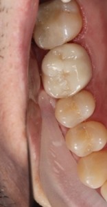 All ceramic crown, tooth crown, cosmetic crown