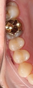 Broken teeth, gold crown, damaged tooth