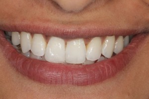 Straight teeth, invisible braces, ceramic brace, teeth whitening