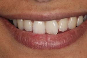 Crooked teeth, discoloured teeth