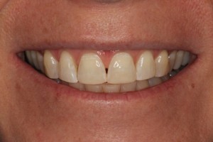 straight even teeth after cosmetic bonding