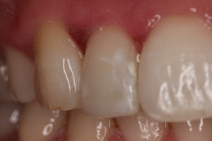 Cosmetic bonding, repaired tooth, symmetrical tooth