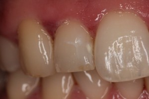 Worn teeth, fractured tooth, tooth wear