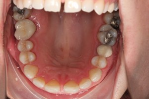 Dental implant, teeth implants, tooth implant