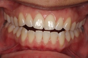 Straight teeth, even teeth, white teeth