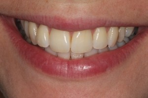 Yellow teeth, discoloured teeth
