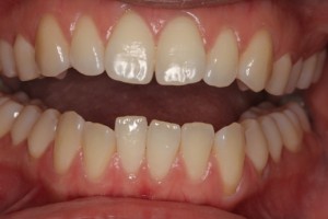 Crooked teeth, teeth straightening