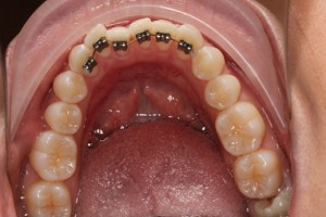Social 6 braces, lingual braces, braces behind the teeth, hidden braces