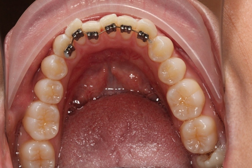 Straight Teeth In 8 Weeks With Social 6 Lingual Braces