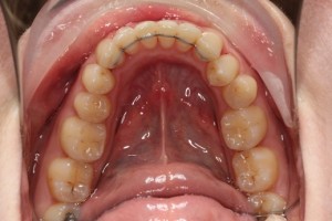 Straight teeth, even teeth, fixed retainer