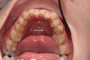 Crooked teeth, poor hygiene, uneven teeth