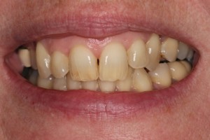 Stained teeth, yellow teeth, discoloured teeth