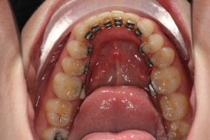 Orthodontics, lingual braces, inside braces, hidden braces