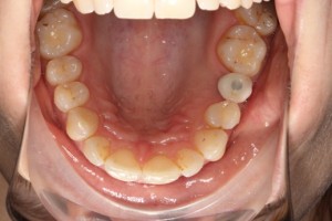 tooth restored with a dental implant, screw retained