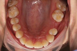 missing tooth, gaps in teeth