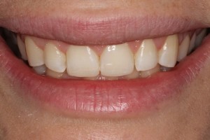 Restored teeth, even teeth, new teeth, symmetrical teeth