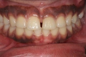 Gappy teeth, mid line space