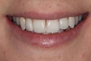 straight teeth, even smile, white teeth
