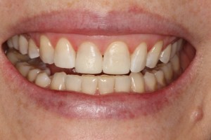 Even symmetrical teeth, white teeth, straight teeth