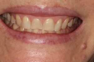 Chipped worn teeth, discoloured