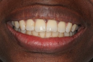 Straight teeth, no gaps