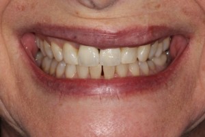 Dental implant, gap restored