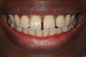 Gappy teeth, spaced teeth