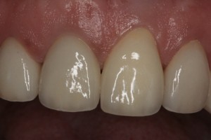 Dental implant to replace a missing front tooth