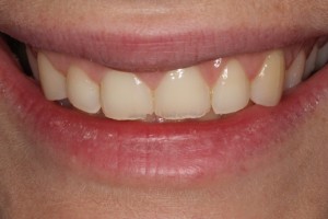 Fractured incisal edges, tooth wear