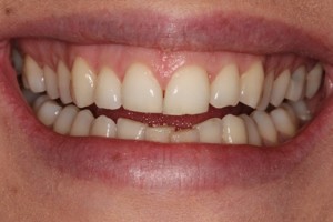Straight even teeth