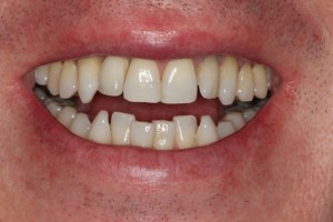 Dental implant replaces tooth