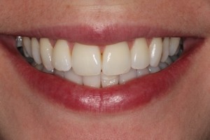 White sparkling teeth