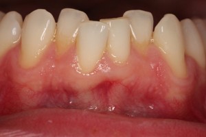 Very crowded lower front teeth