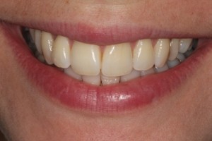 Yellow, discoloured teeth