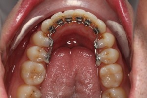 Braces placed on the inside of the teeth
