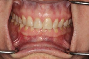 Restored front teeth using dahl technique