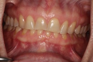 Heavily worn front teeth