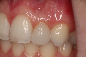 new tooth, normal size & shape after cosmetic bonding