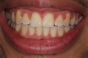gap closed fully between front teeth using a cosmetic brace