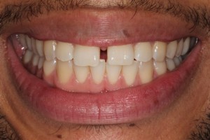 Gap between the front teeth