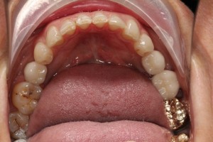 Dental implant crowns