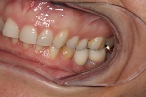 New dental implant teeth
