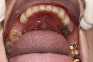 Missing molar teeth