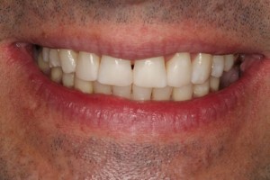 Newly restored teeth