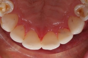 Restored palatal surfaces