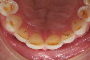 Severe tooth wear