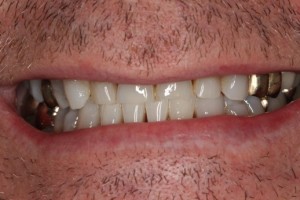 Severe tooth wear
