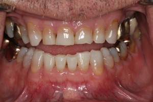 severe tooth wear